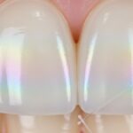 Sbiancamento denti